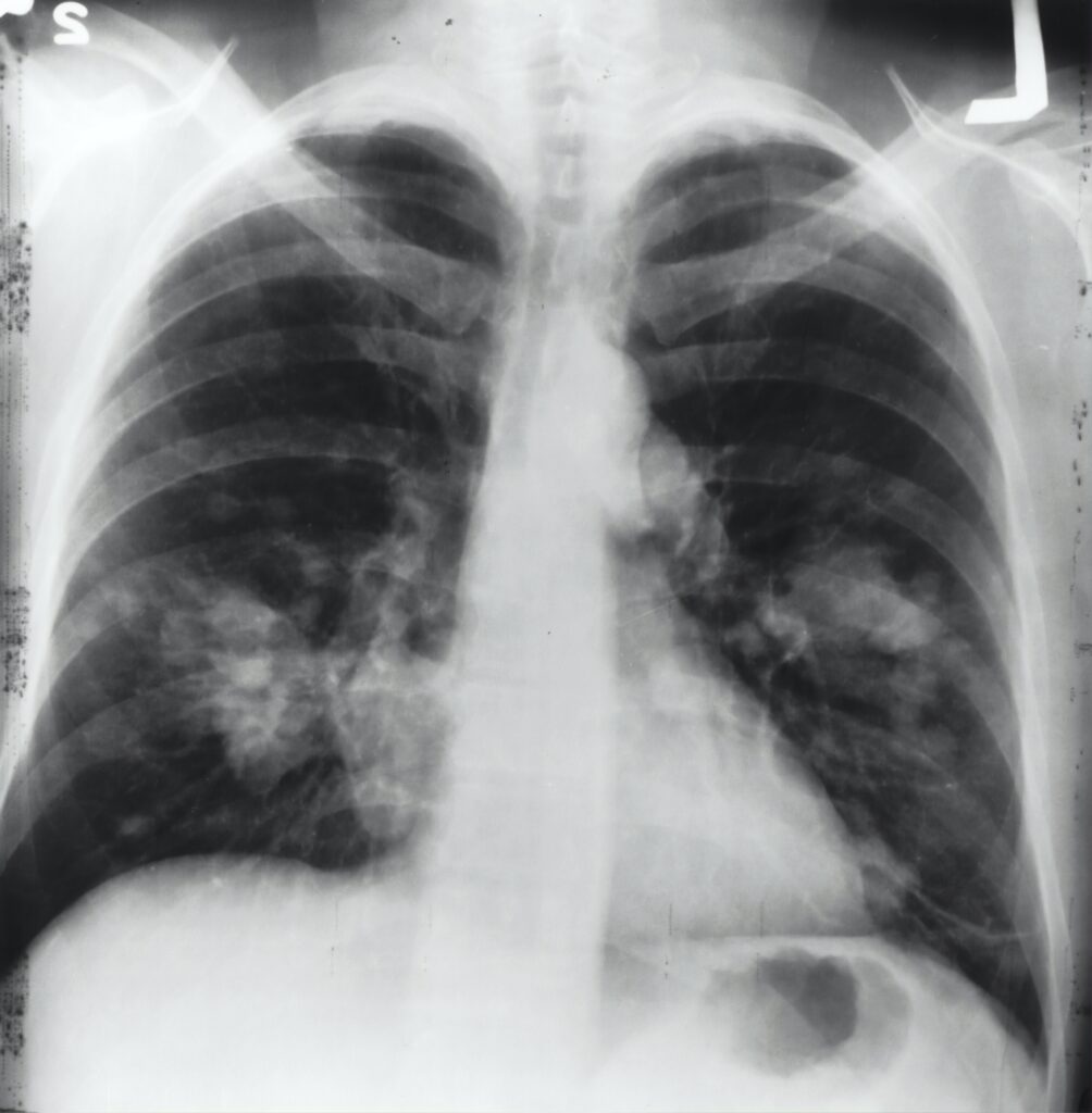 Röntgenaufnahme einer Lunge, mit einigen Schatten darauf.